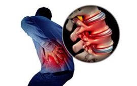 disc bulge sciatica featured